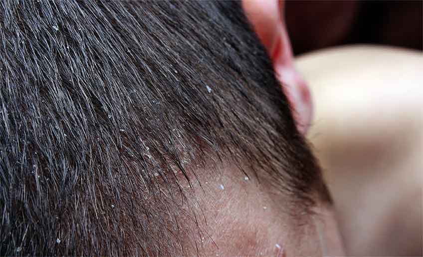 Masalah Rambut Dry Scalp pada Pria dan Solusinya