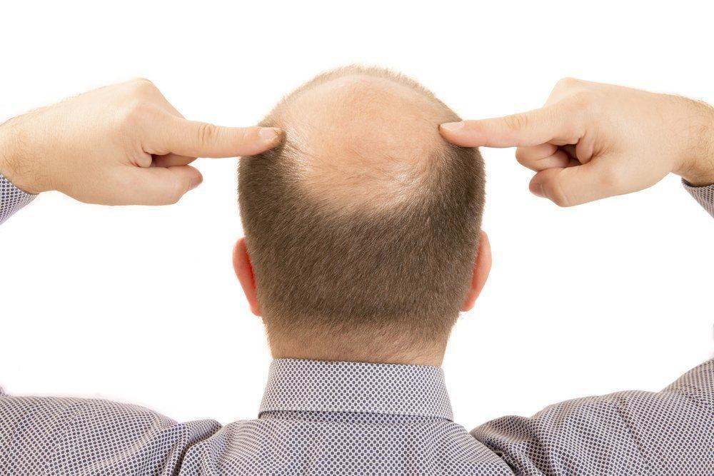 Masalah Rambut botak / kebotakan pada Pria dan Solusinya